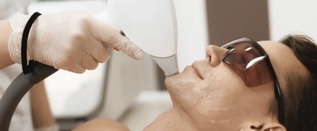 Épilation Laser Visage